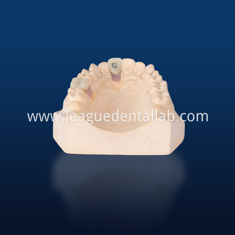 Dental Implant Crown, Dental Implant Zirconia crown,Dental Implant Emax crown,Dental Implant Bridge